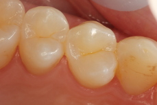 Dental Filling After a Root Canal - Casas Adobes Dentistry Tucson Arizona